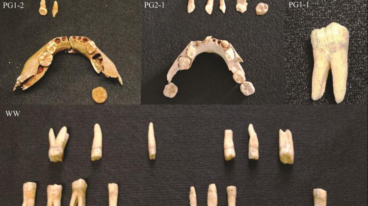 Tooth decay was the major problem for our ancestors 9,000 years ago
