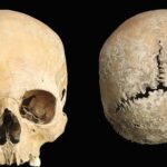 An Anglo-Saxon girl had her nose and lips cut off as punishment, an ancient skull shows