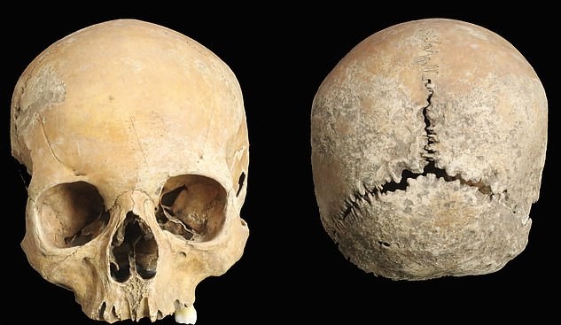 An Anglo-Saxon girl had her nose and lips cut off as punishment, an ancient skull shows